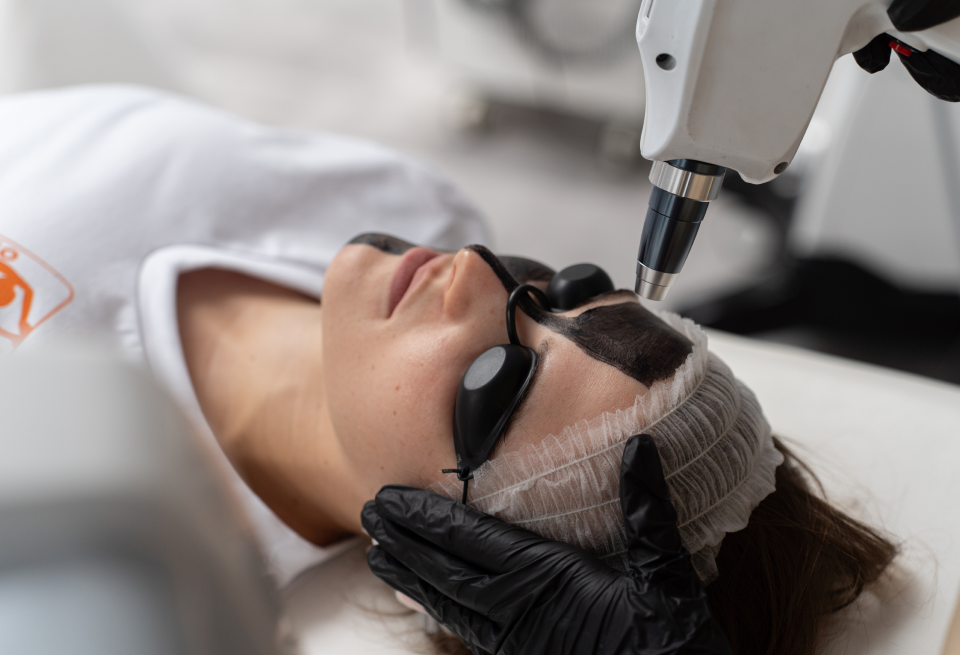 Peeling węglowy w Studio Figura Łódź – peeling laserowy oczyszczający cerę